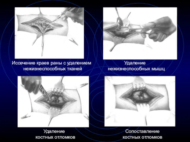 Иссечение краев раны с удалением нежизнеспособных тканей Удаление нежизнеспособных мышц Удаление костных отломков Сопоставление костных отломков
