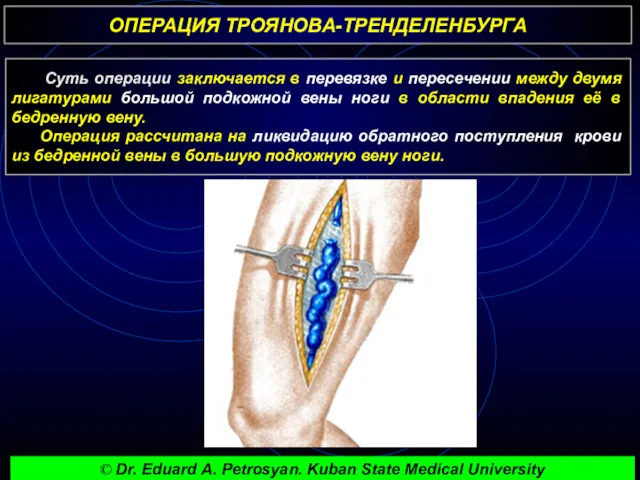 ОПЕРАЦИЯ ТРОЯНОВА-ТРЕНДЕЛЕНБУРГА Суть операции заключается в перевязке и пересечении между