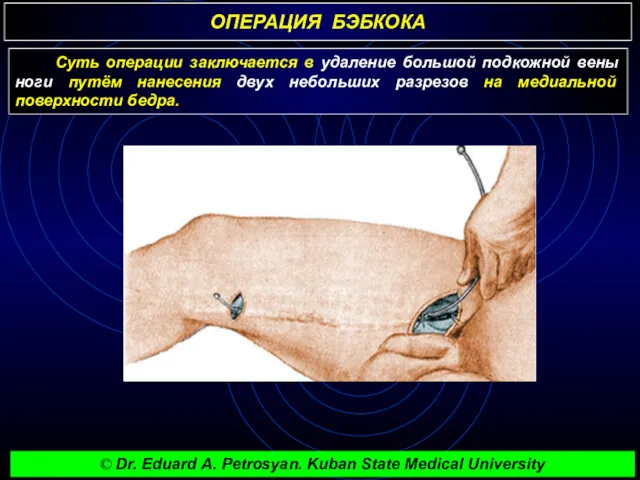 ОПЕРАЦИЯ БЭБКОКА Суть операции заключается в удаление большой подкожной вены