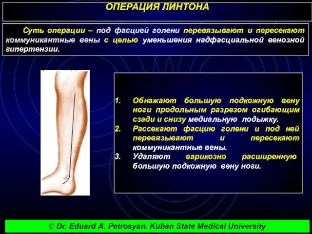 ОПЕРАЦИЯ ЛИНТОНА Обнажают большую подкожную вену ноги продольным разрезом огибающим