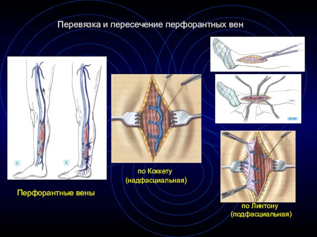Перевязка и пересечение перфорантных вен по Линтону (подфасциальная) по Коккету (надфасциальная) Перфорантные вены