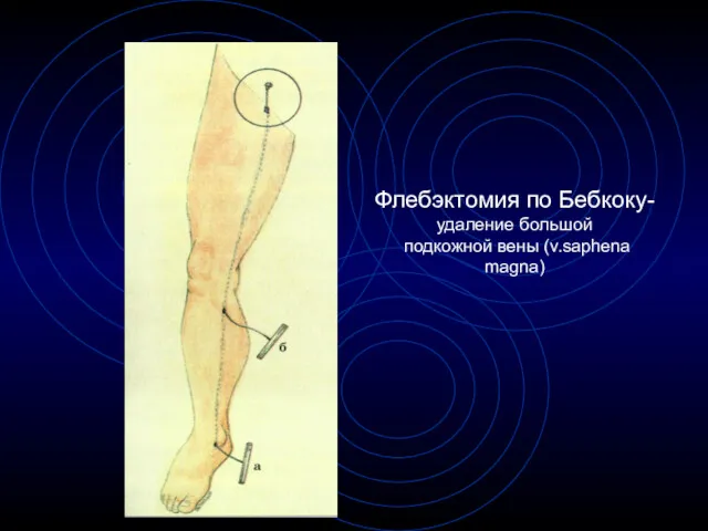 Флебэктомия по Бебкоку- удаление большой подкожной вены (v.saphena magna)