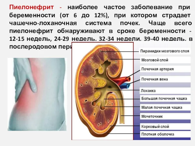 Пиелонефрит - наиболее частое заболевание при беременности (от 6 до