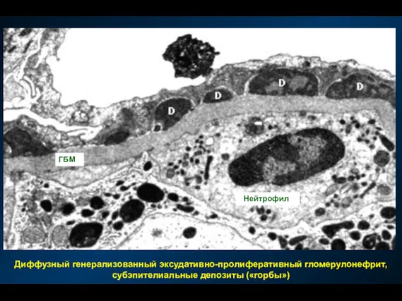 Диффузный генерализованный эксудативно-пролиферативный гломерулонефрит, субэпителиальные депозиты («горбы») Нейтрофил ГБМ