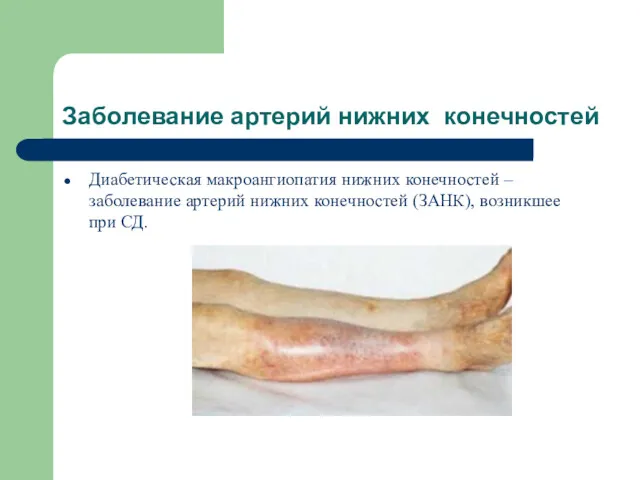 Заболевание артерий нижних конечностей Диабетическая макроангиопатия нижних конечностей – заболевание артерий нижних конечностей