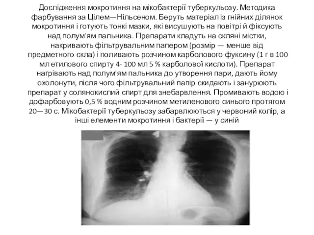 Дослідження мокротиння на мікобактерії туберкульозу. Методика фарбування за Цілем—Нільсеном. Беруть