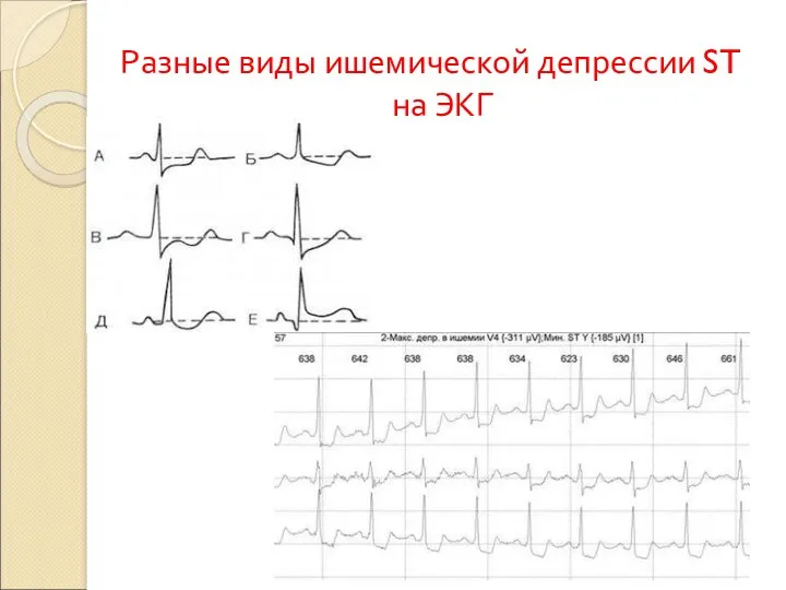 Разные виды ишемической депрессии ST на ЭКГ