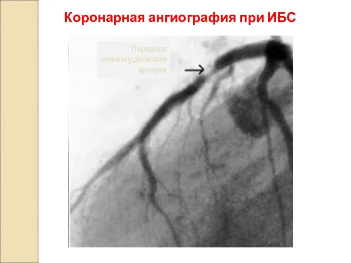 Коронарная ангиография при ИБС Передняя межжелудочковая артерия