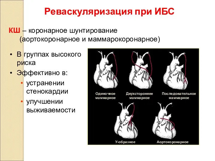 Реваскуляризация при ИБС КШ – коронарное шунтирование (аортокоронарное и маммарокоронарное)