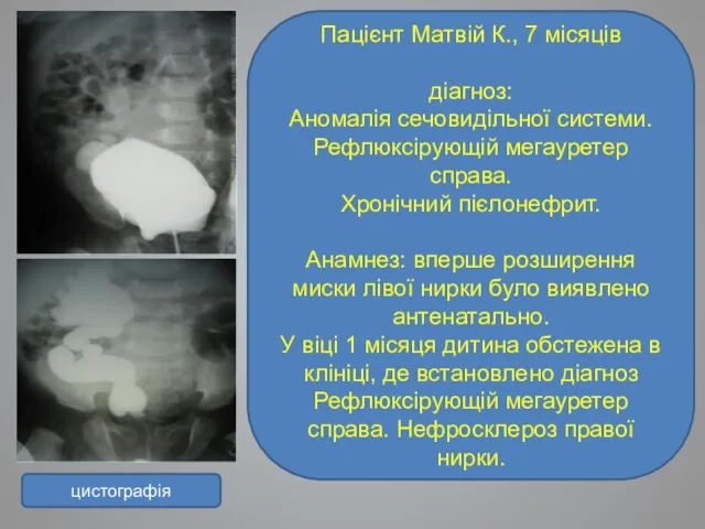 Пацієнт Матвій К., 7 місяців діагноз: Аномалія сечовидільної системи. Рефлюксірующій