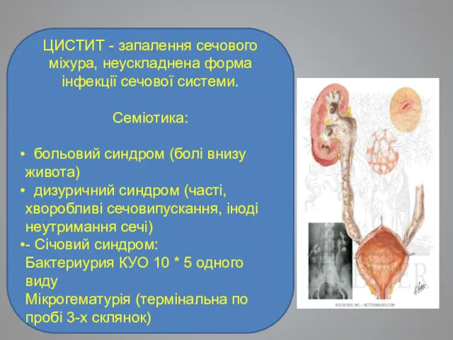 ЦИСТИТ - запалення сечового міхура, неускладнена форма інфекції сечової системи.