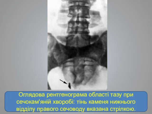 Оглядова рентгенограма області тазу при сечокам'яній хворобі: тінь каменя нижнього відділу правого сечоводу вказана стрілкою.
