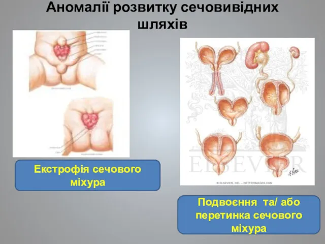 Аномалії розвитку сечовивідних шляхів Екстрофія сечового міхура Подвоєння та/ або перетинка сечового міхура