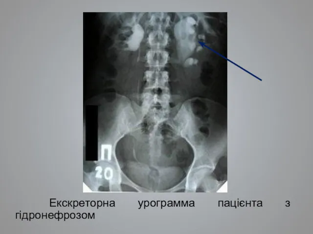 Екскреторна урограмма пацієнта з гідронефрозом