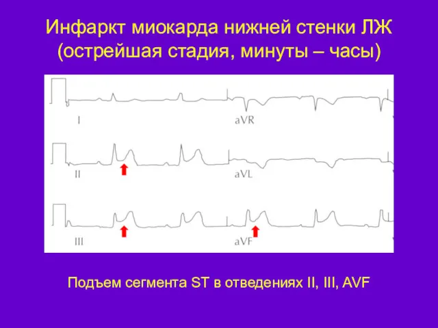 Инфаркт миокарда нижней стенки ЛЖ (острейшая стадия, минуты – часы)