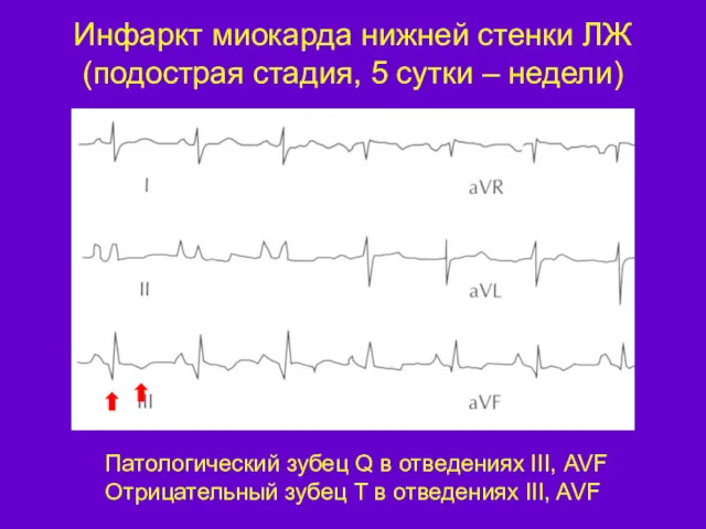 Инфаркт миокарда нижней стенки ЛЖ (подострая стадия, 5 сутки –