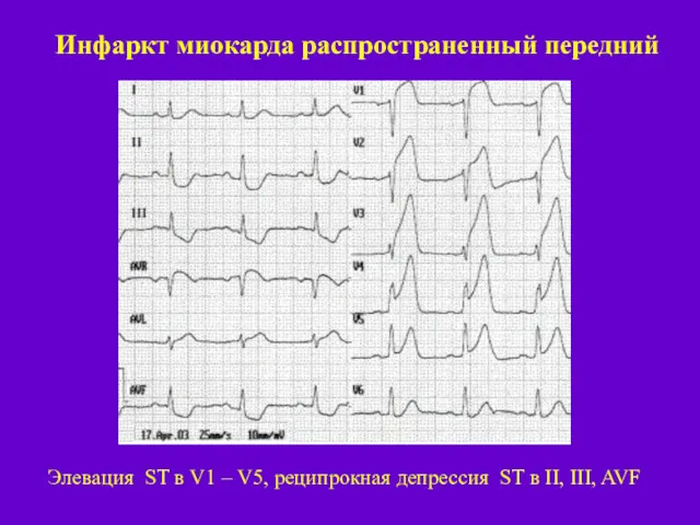 Инфаркт миокарда распространенный передний Элевация ST в V1 – V5,