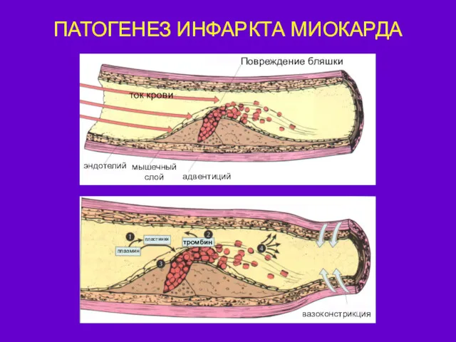 ПАТОГЕНЕЗ ИНФАРКТА МИОКАРДА ток крови Повреждение бляшки эндотелий мышечный слой адвентиций плазмин пластинки тромбин вазоконстрикция