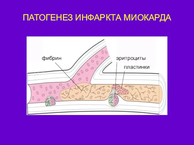 ПАТОГЕНЕЗ ИНФАРКТА МИОКАРДА фибрин пластинки эритроциты