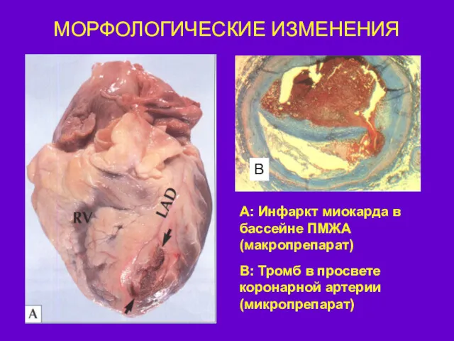 МОРФОЛОГИЧЕСКИЕ ИЗМЕНЕНИЯ B А: Инфаркт миокарда в бассейне ПМЖА (макропрепарат)