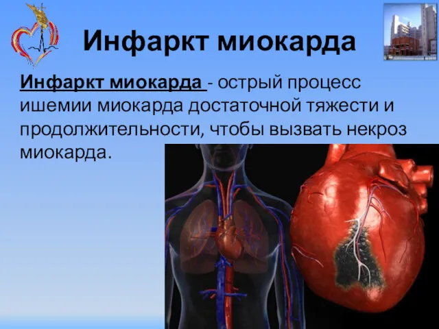 Инфаркт миокарда Инфаркт миокарда - острый процесс ишемии миокарда достаточной