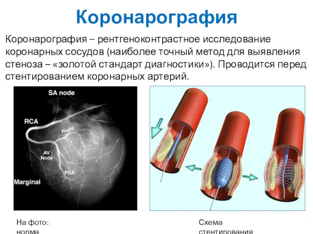 Коронарография Коронарография – рентгеноконтрастное исследование коронарных сосудов (наиболее точный метод