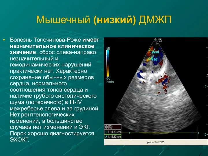 Мышечный (низкий) ДМЖП Болезнь Толочинова-Роже имеет незначительное клиническое значение, сброс