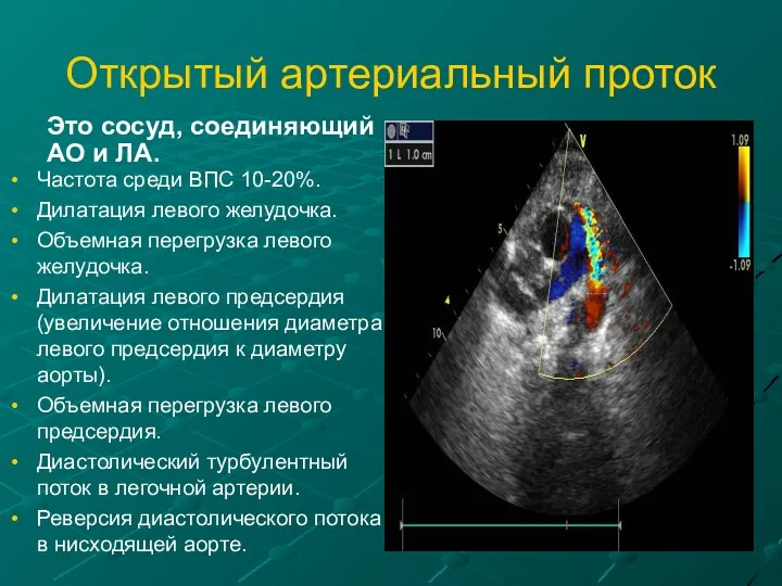 Открытый артериальный проток Это сосуд, соединяющий АО и ЛА. Частота