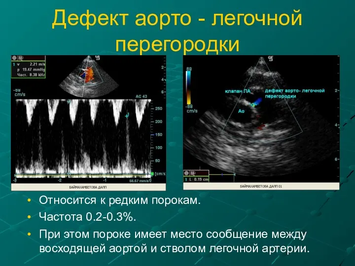 Дефект аорто - легочной перегородки Относится к редким порокам. Частота