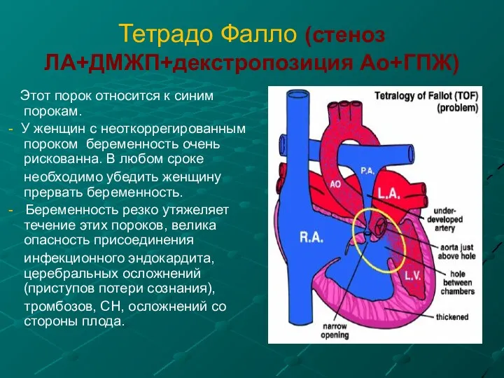 Тетрадо Фалло (стеноз ЛА+ДМЖП+декстропозиция Ао+ГПЖ) Этот порок относится к синим