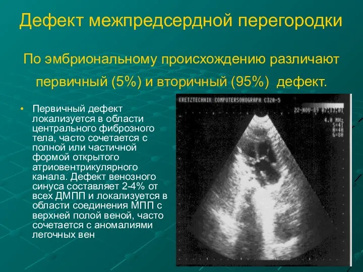 Дефект межпредсердной перегородки По эмбриональному происхождению различают первичный (5%) и