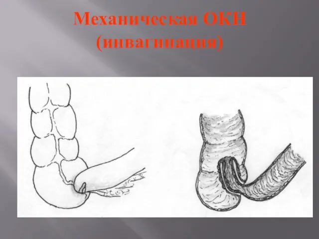 Механическая ОКН (инвагинация)