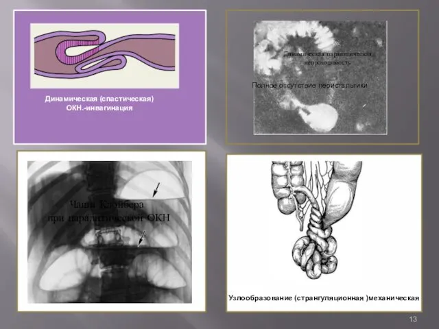 Динамическая (спастическая) ОКН.-инвагинация Полное отсутствие перистальтики Чаши Клойбера при паралитической