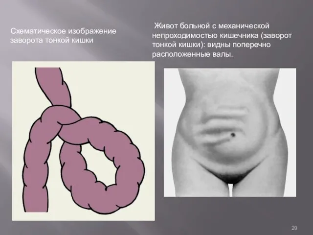 Схематическое изображение заворота тонкой кишки Живот больной с механической непроходимостью