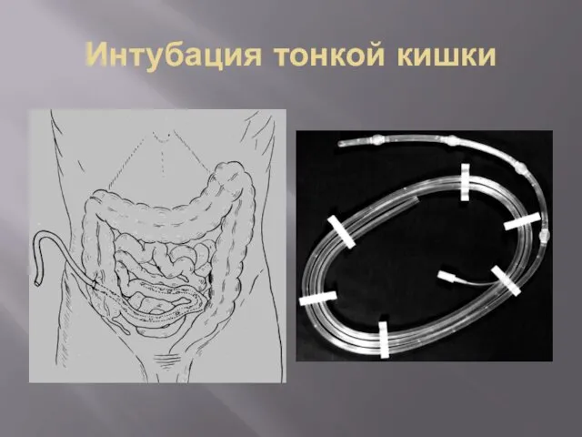 Интубация тонкой кишки