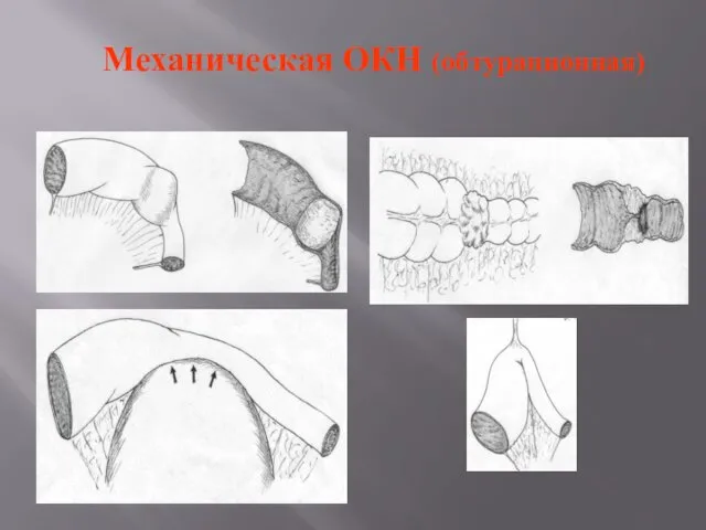 Механическая ОКН (обтурационная)