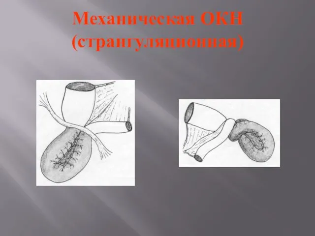 Механическая ОКН (странгуляционная)