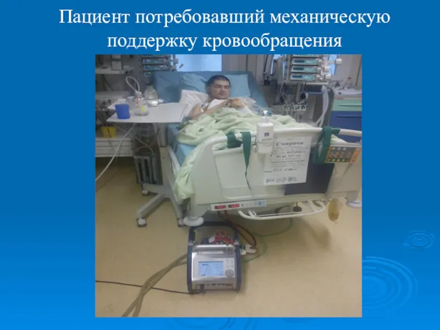 Пациент потребовавший механическую поддержку кровообращения