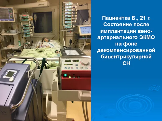 Пациентка Б., 21 г. Состояние после имплантации вено-артериального ЭКМО на фоне декомпенсированной бивентрикулярной СН