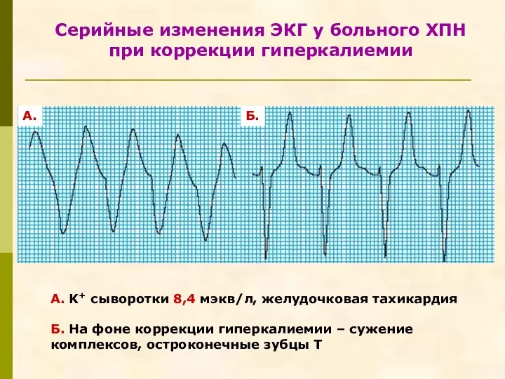Серийные изменения ЭКГ у больного ХПН при коррекции гиперкалиемии А. K+ сыворотки 8,4