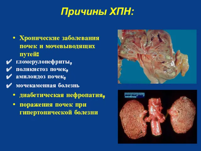 Хронические заболевания почек и мочевыводящих путей: гломерулонефриты, поликистоз почек, амилоидоз