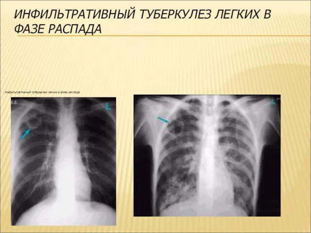 . Инфильтративный туберкулез легких в фазе распада ИНФИЛЬТРАТИВНЫЙ ТУБЕРКУЛЕЗ ЛЕГКИХ В ФАЗЕ РАСПАДА