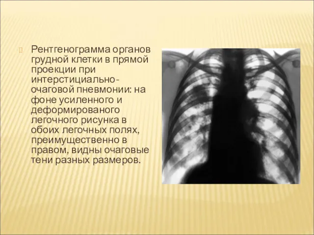 Рентгенограмма органов грудной клетки в прямой проекции при интерстициально-очаговой пневмонии: