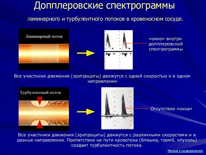 Допплеровские спектрограммы ламинарного и турбулентного потоков в кровеносном сосуде. «окно» внутри допплеровской спектрограммы