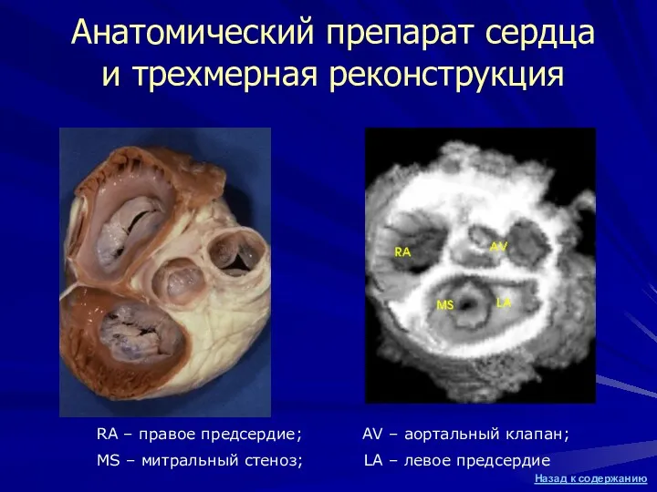 Анатомический препарат сердца и трехмерная реконструкция RA – правое предсердие; AV – аортальный