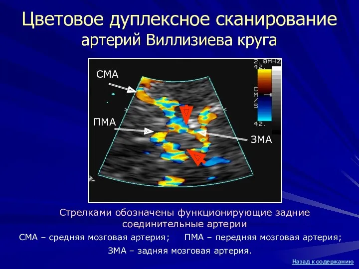 Цветовое дуплексное сканирование артерий Виллизиева круга Стрелками обозначены функционирующие задние соединительные артерии ЗМА