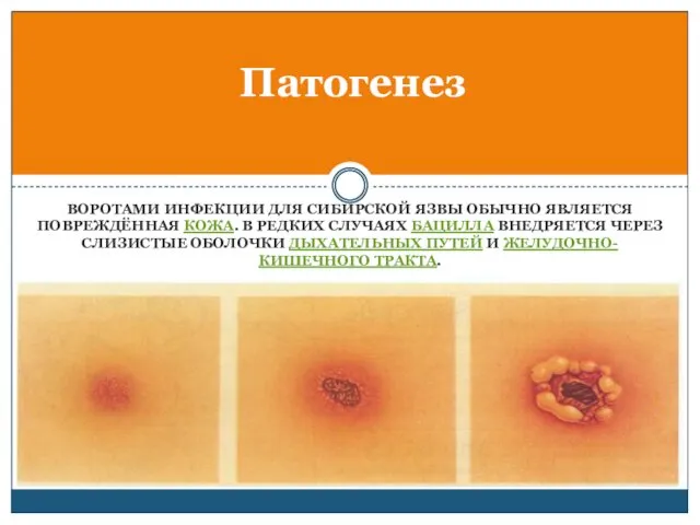 ВОРОТАМИ ИНФЕКЦИИ ДЛЯ СИБИРСКОЙ ЯЗВЫ ОБЫЧНО ЯВЛЯЕТСЯ ПОВРЕЖДЁННАЯ КОЖА. В