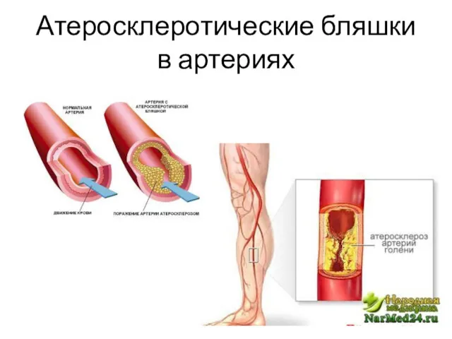 Атеросклеротические бляшки в артериях