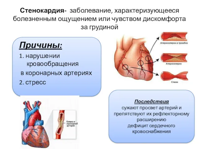 Стенокардия- заболевание, характеризующееся болезненным ощущением или чувством дискомфорта за грудиной