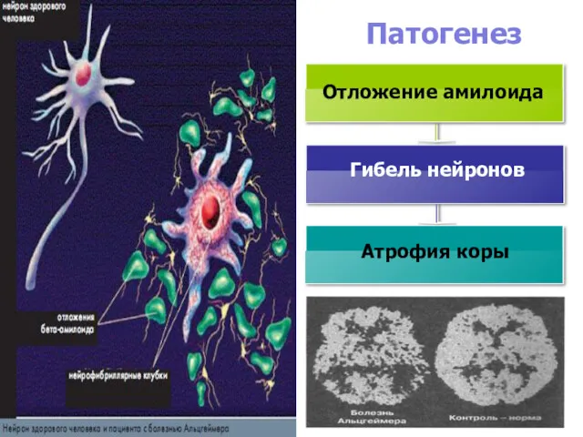 Гибель нейронов Атрофия коры Отложение амилоида Патогенез